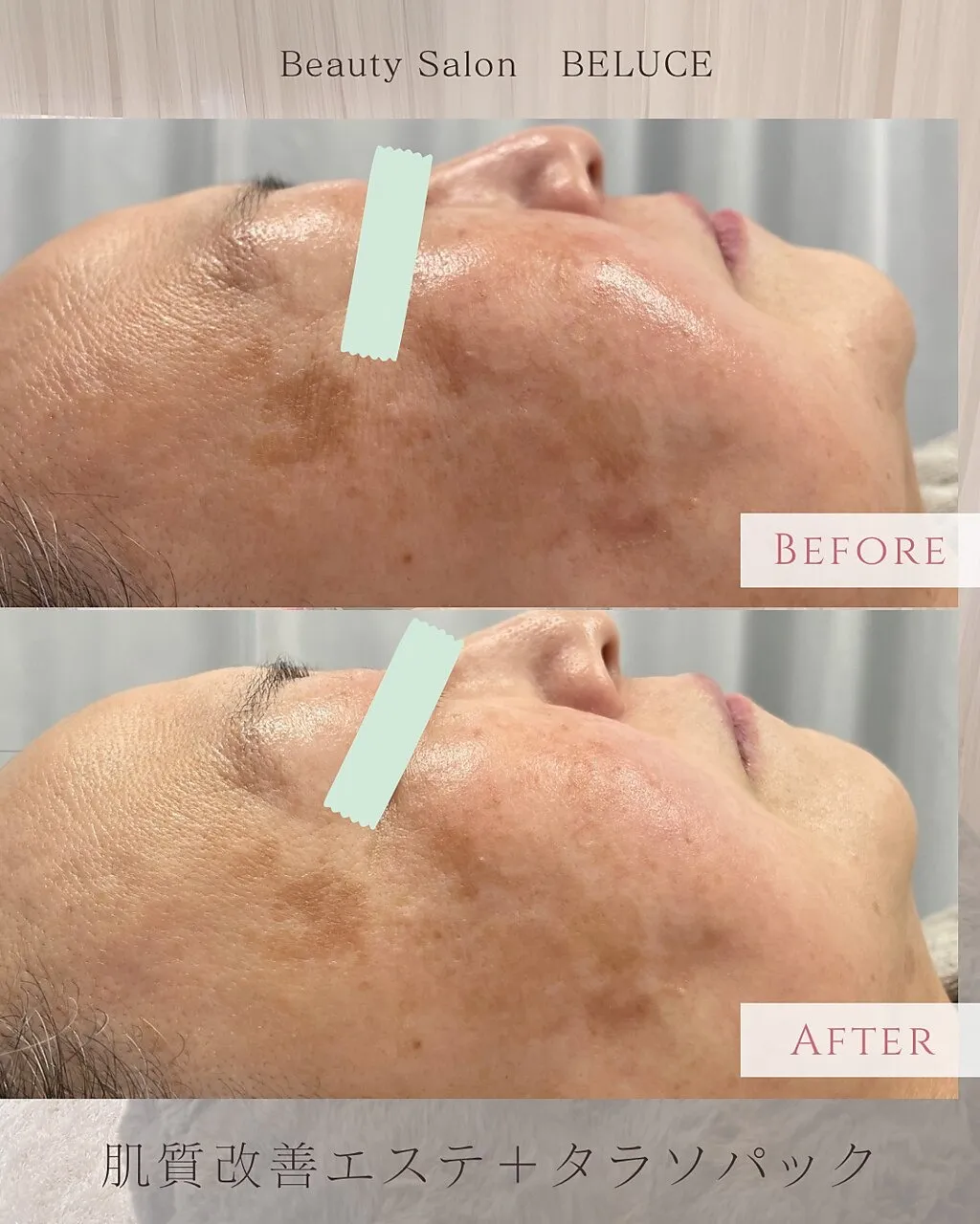 タラソパックでミネラル補給